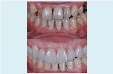 Crowns at DentGroup