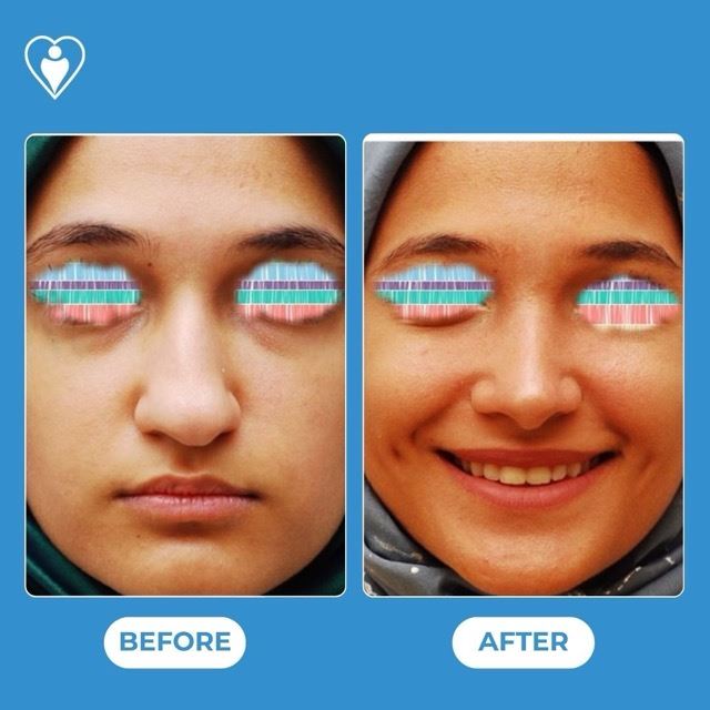 Rhinoplasty, before and after, Luna Clinic Turkey