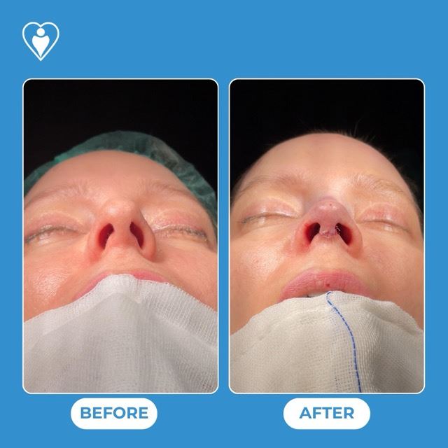 Rhinoplasty, before and after, Luna Clinic Turkey
