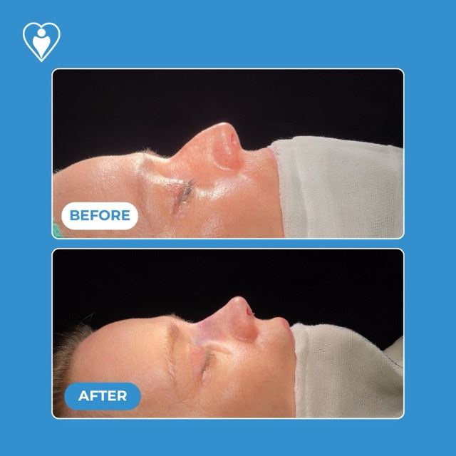 Rhinoplasty, before and after, Luna Clinic Turkey