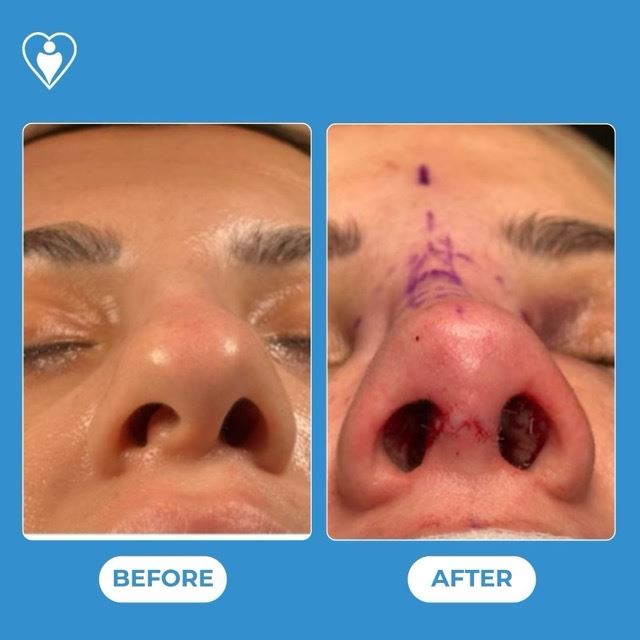 Rhinoplasty, before and after, Luna Clinic Turkey