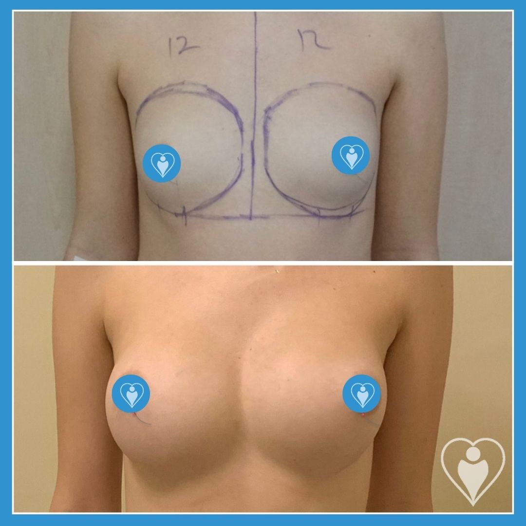 Breast implants, before and after, Luna Clinic Turkey