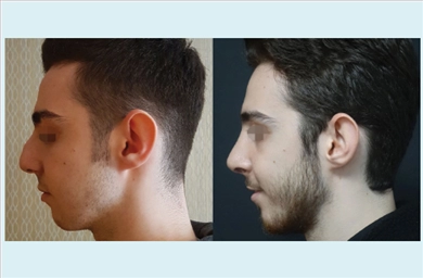 Complicated Rhinoplasty at Dr. Ozge Ergun Plastic Surgery Clinic