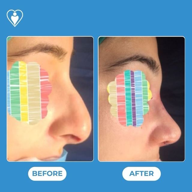 Rhinoplasty, before and after, Luna Clinic Turkey