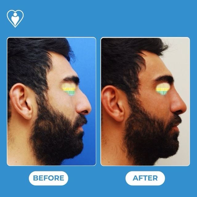 Rhinoplasty, before and after, Luna Clinic Turkey