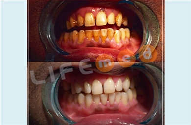 Teeth Whitening at Lifemed Medical Center