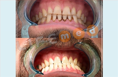 Teeth Whitening at Lifemed Medical Center