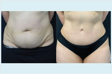 Tummy Tuck at Dr. Ozge Ergun Plastic Surgery Clinic