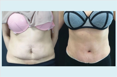 Tummy Tuck at Dr. Ozge Ergun Plastic Surgery Clinic