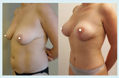 Tummy Tuck at Dr. Ozge Ergun Plastic Surgery Clinic