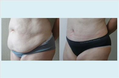 Tummy Tuck at Dr. Ozge Ergun Plastic Surgery Clinic