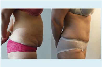 Tummy Tuck at Dr. Ozge Ergun Plastic Surgery Clinic