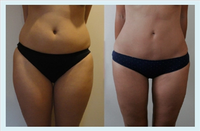Thigh Lift at Dr. Ozge Ergun Plastic Surgery Clinic