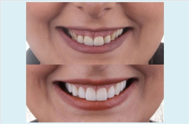 Veneers at DentGroup