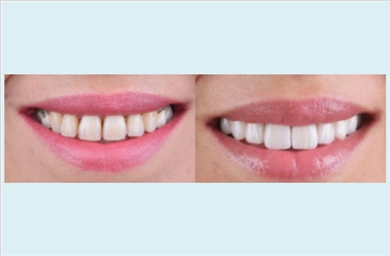 Veneers at DentGroup