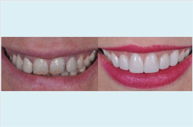 Veneers at DentGroup