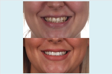 Veneers at DentGroup