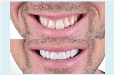 Veneers at DentGroup