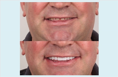 Veneers at DentGroup
