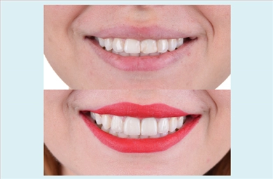 Veneers at DentGroup