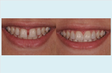 Veneers at DentGroup