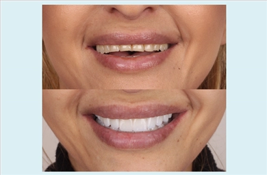 Veneers at DentGroup