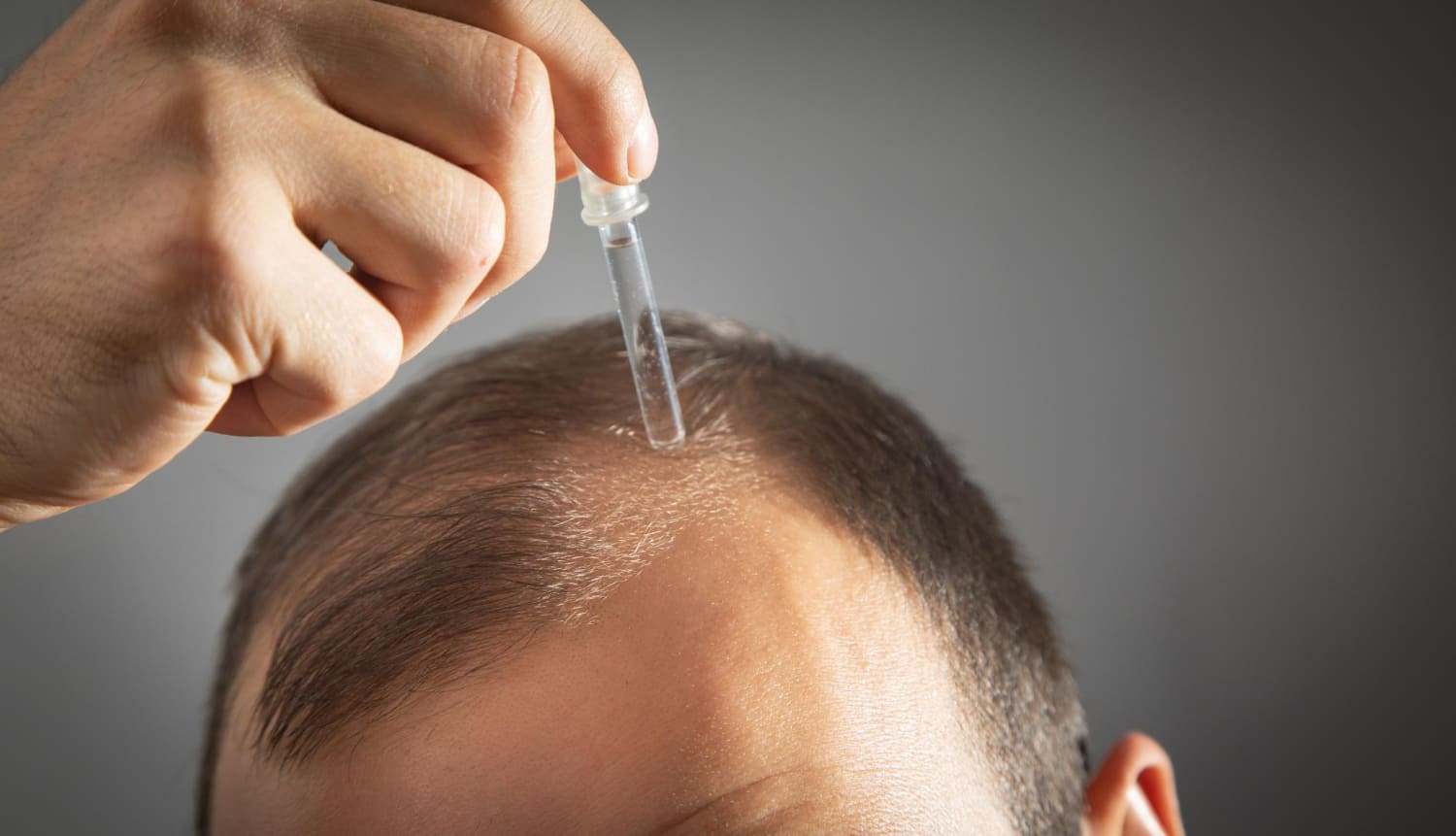 Titelbild für Hair Transplant Without Finasteride: Do You Really Need it?