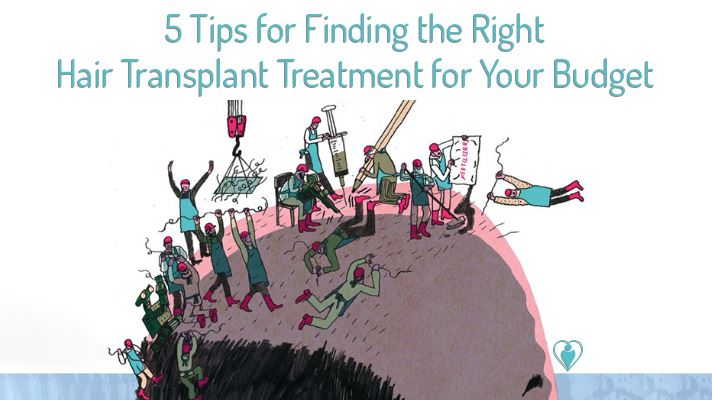 5 Tips for Finding the Right Hair Transplant Treatment for Your Budget