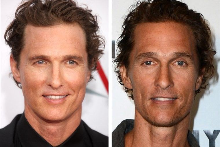 New Celebrity Hair Transplants Before and After!