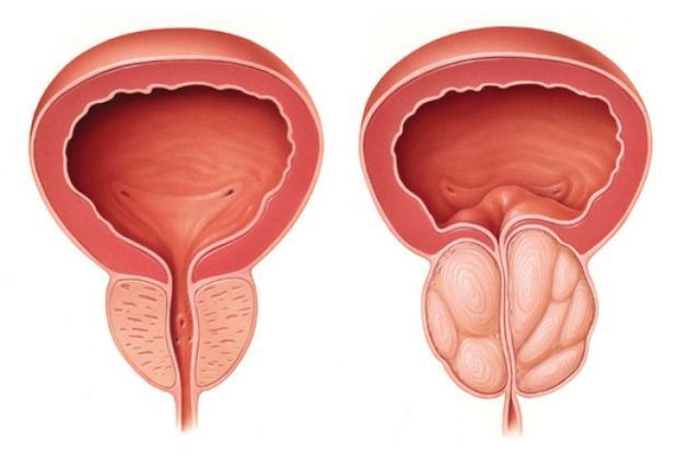 How to Prevent Prostate Cancer?