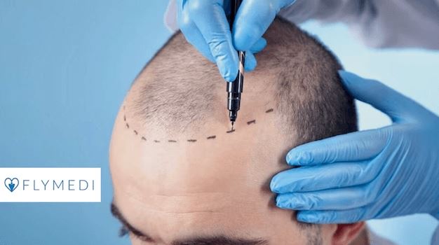 Immagine di copertina per Does Hair Transplant Hurt?