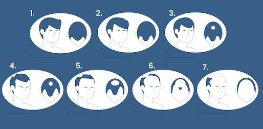 Cover image for Understanding the Stages of Hair Loss: The Norwood Scale