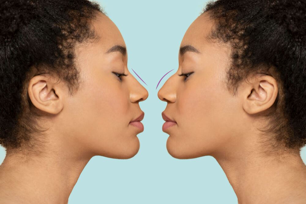 Ethnic Rhinoplasty: How Hip-Hop Celebrities Reshaped the Conversation Around Nose Jobs