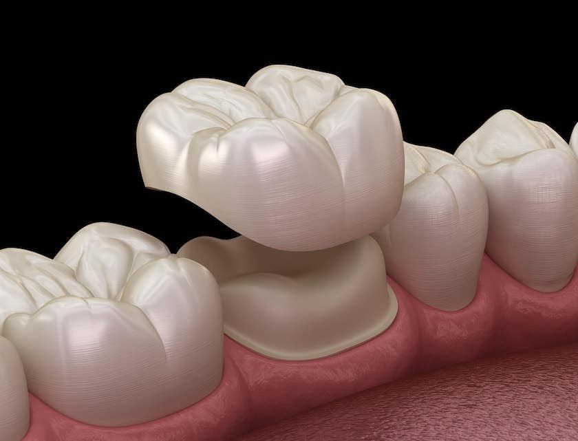 How Much Does a Dental Crown Cost?