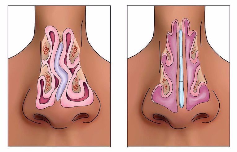 How Much Does a Septoplasty Surgery Cost?