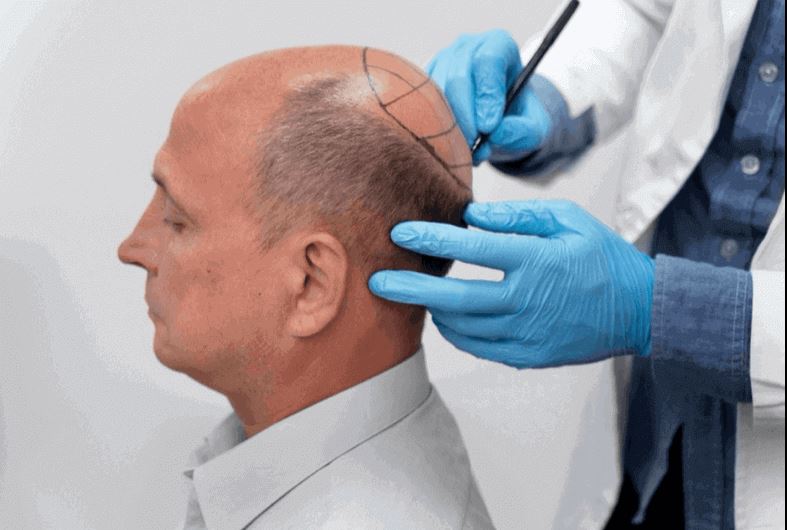 Titelbild für How To Care For Hair Transplant Scabs - Expert's Recovery Tips 
