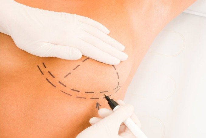 10 Things You Want To Know About Breast Augmentation