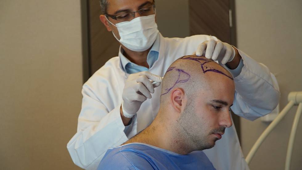 Having Hair Transplant in Istanbul: Why Is It Popular?