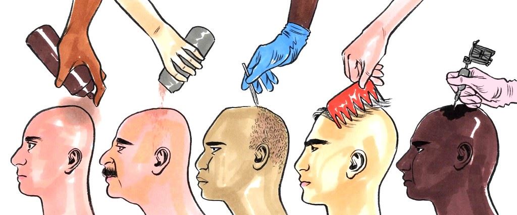 Celebrities Who Had Hair Transplant Surgery