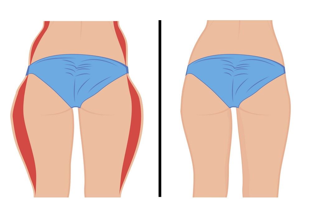 How Much Does Liposuction Cost Worldwide?