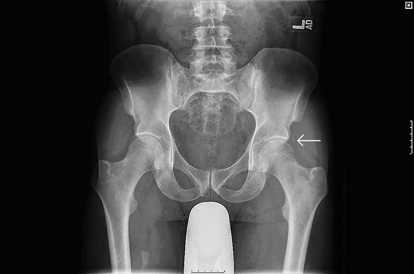 Cover image for Total Hip Replacement Surgery Recovery Time