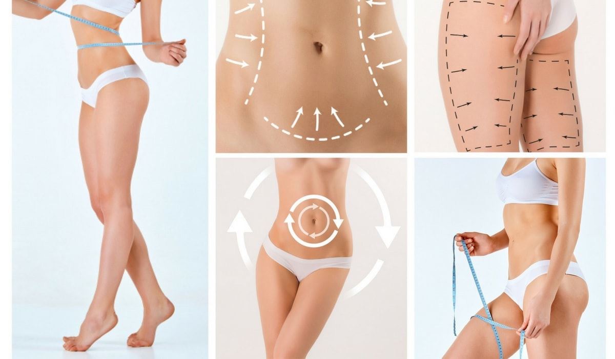 Body Lift Surgery - Things You Need to Know