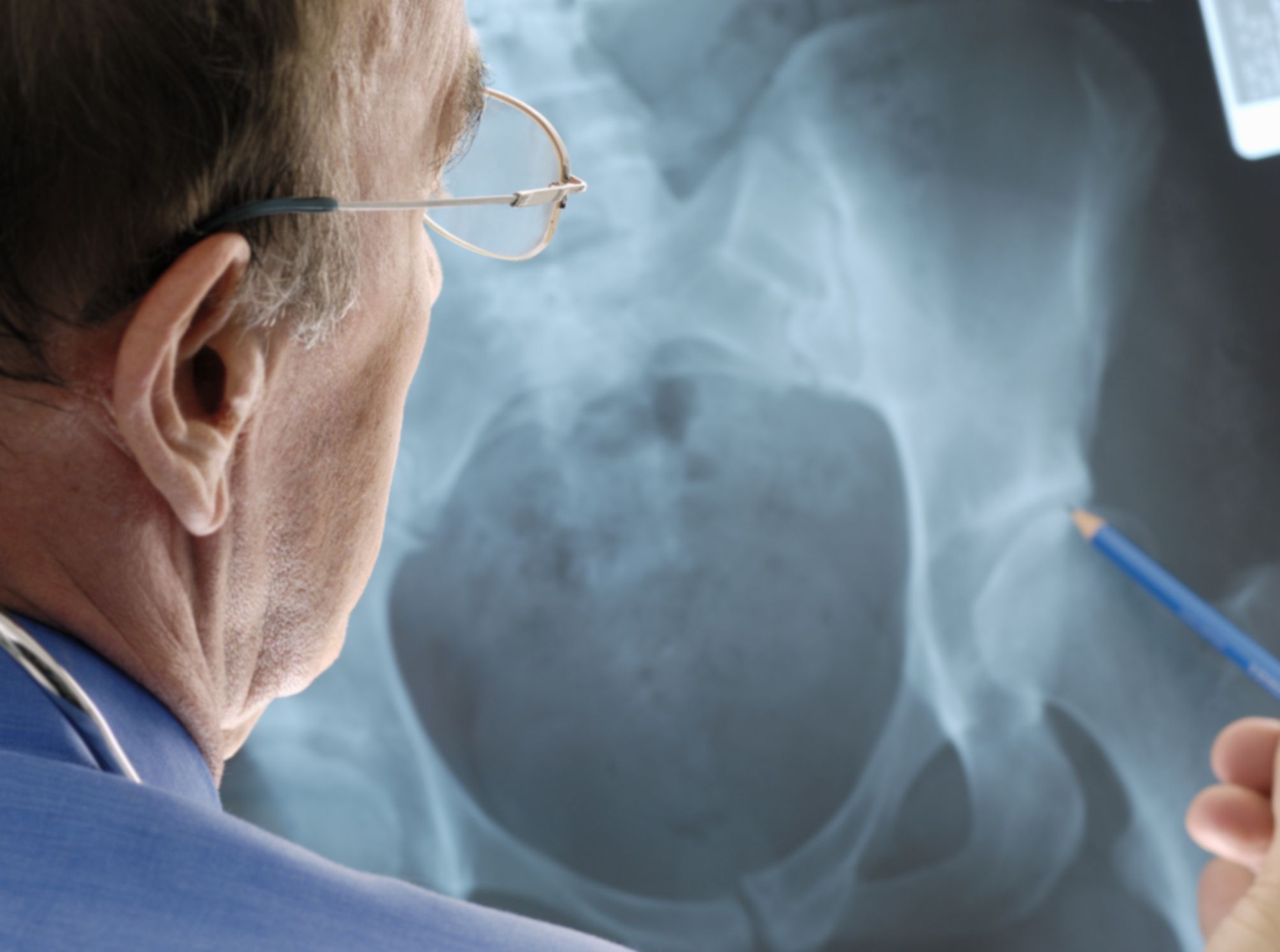 Hip Replacement Cost Around The World