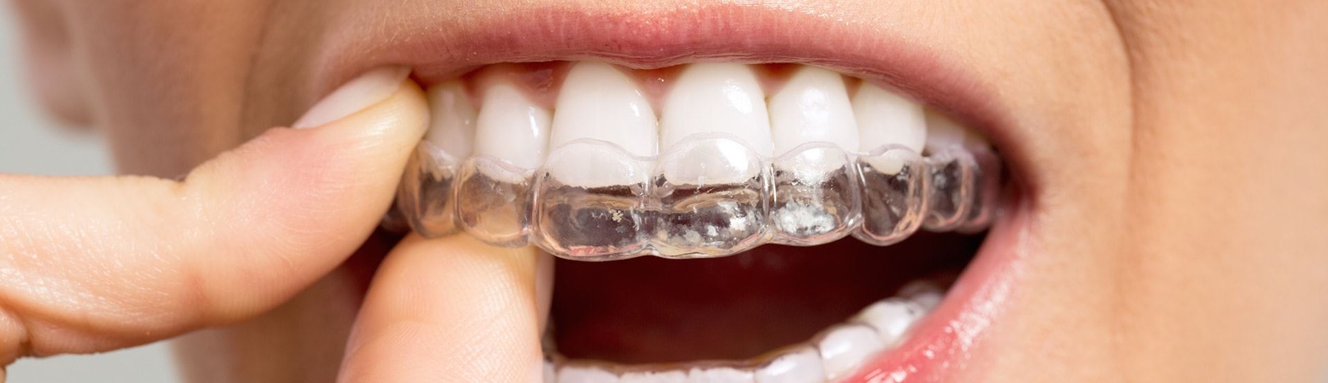 Things You Should Know About Invisalign
