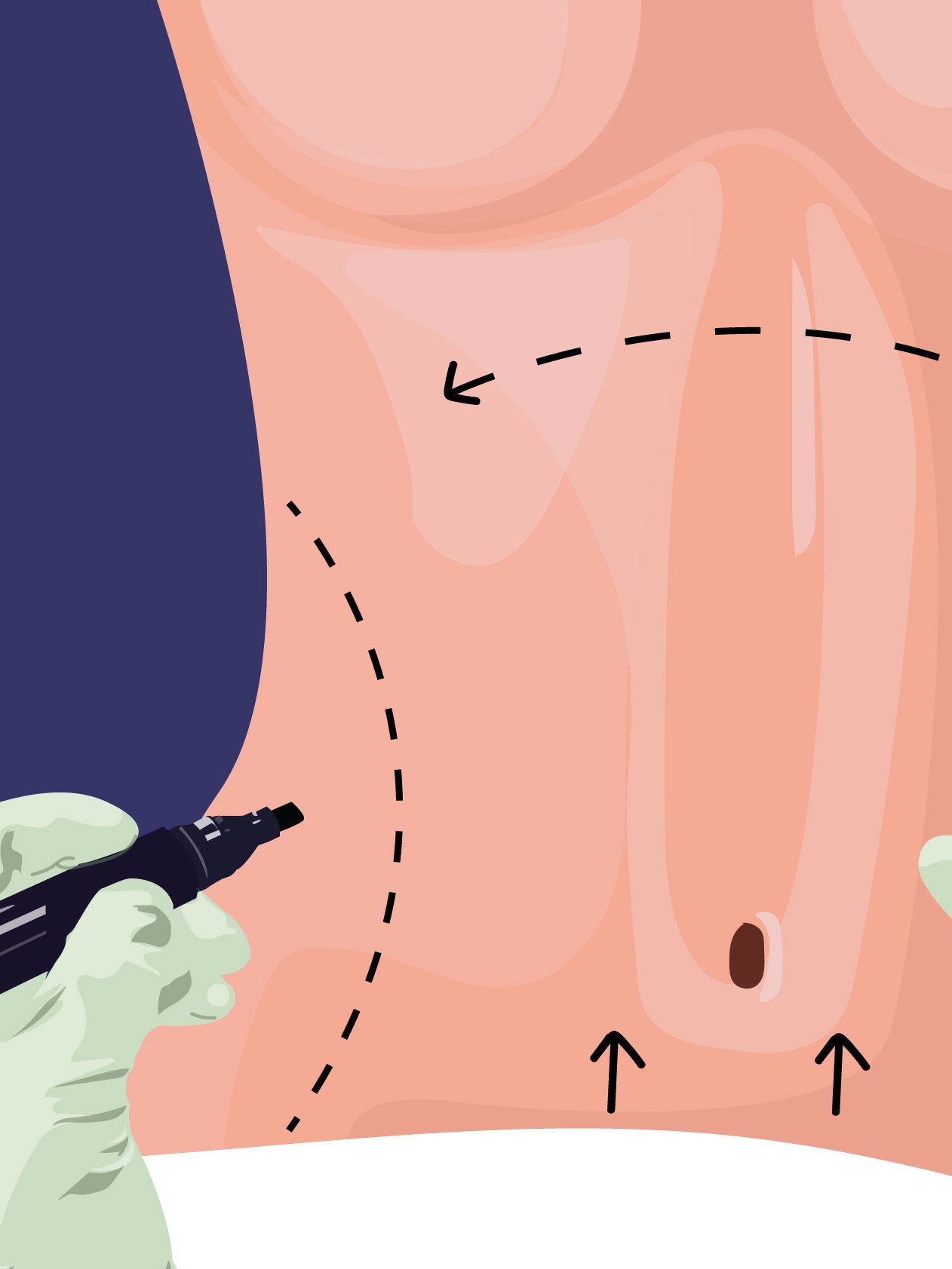 Cover image for How Much Does a Tummy Tuck Cost? - World Prices