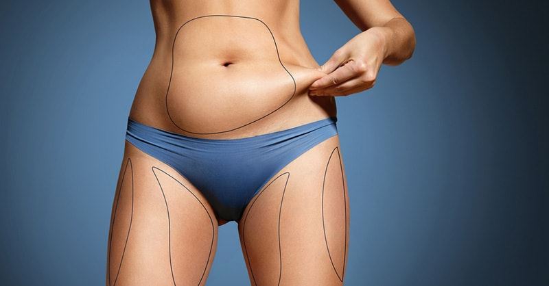 Cover image for Liposuction In Turkey: How is it Performed?
