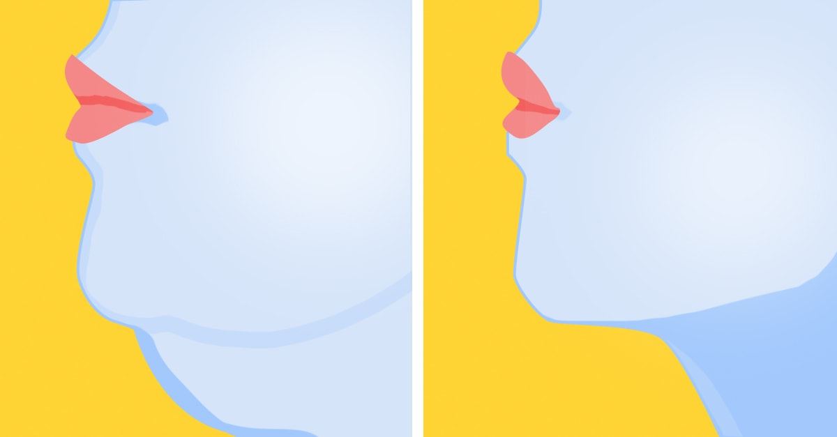 Chin Reduction Important Facts: Cost, Reviews