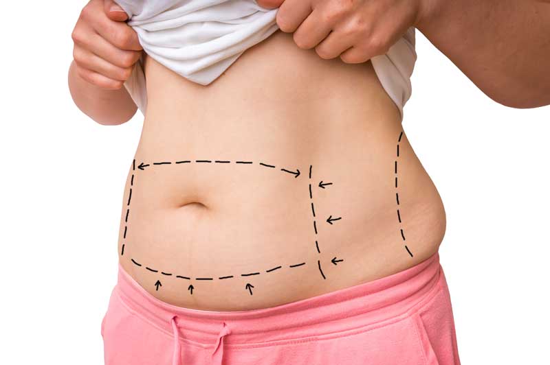 Cover image for 4 Different Techniques of Tummy Tuck Explained