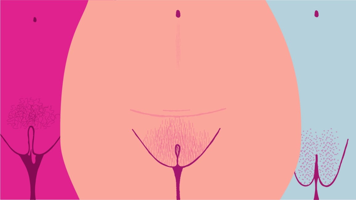 What You Need to Know About Vaginoplasty