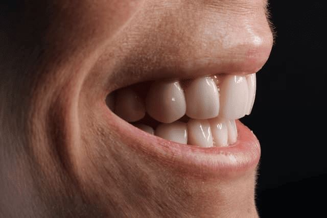 Titelbild für What Are Gingival Veneers and Are They Right for You